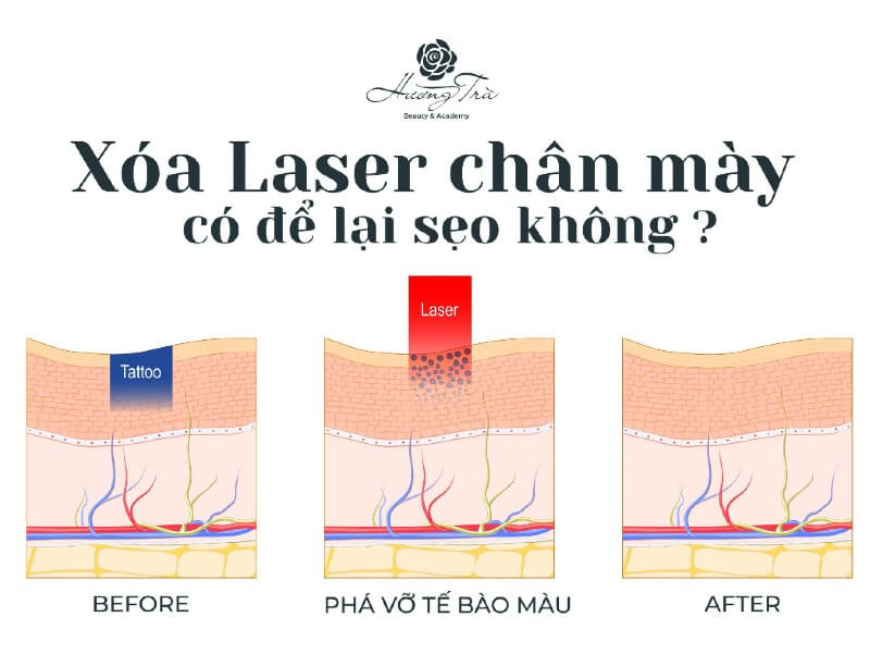 Xóa chân mày bằng laser có để lại sẹo không? 2 HTBA Xoa laser chan may de lai seo khong 0 2