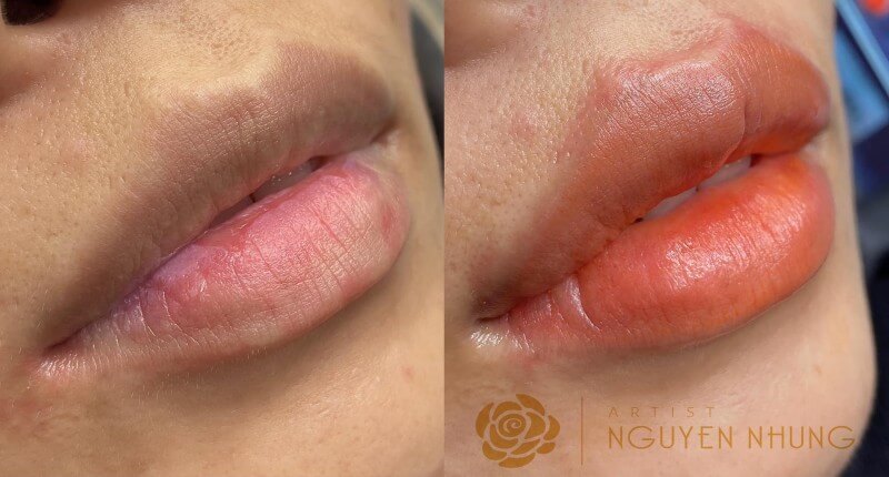 Cấp độ thâm môi và sự thật về khử môi thâm 2 HTBA khu tham moi 03