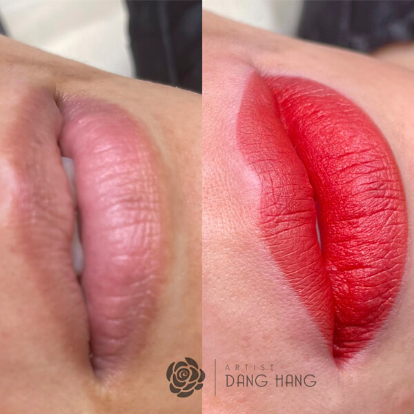 Có nên khử thâm môi và phun môi không? Quy trình khử thâm môi và phun môi như thế nào? 2 Khử môi thâm và phun môi bằng công nghệ hiện đại